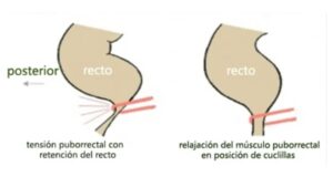 hemorroides embarazo posturas